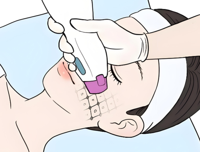 2026韩国爆火的面部紧致项目分享：Ultherapy、Thermage、HIFU区别与2026价格表